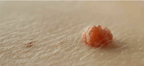 Virus del papiloma