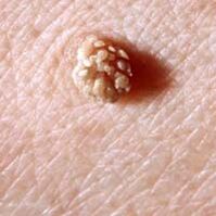 virus del papiloma humano en la piel