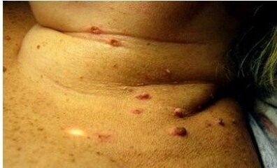 Fotos de muchas papilomas en mujeres