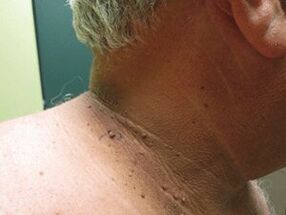 Las razones de la aparición de papilomas plurales en el cuerpo
