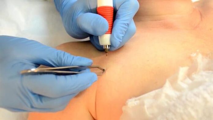 Electrocoagulación un método para eliminar papilomas.