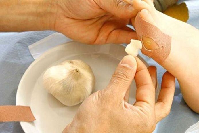 Tratamiento del papiloma con compresa de ajo.