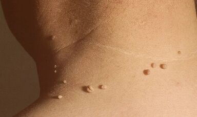 causas de los papilomas