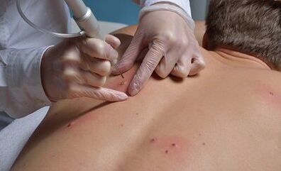 formas de eliminar los papilomas