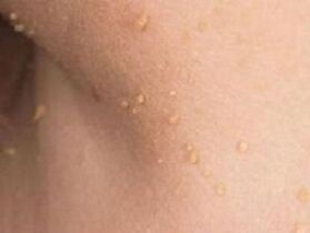 Razones de la aparición de papilomas en el cuerpo.
