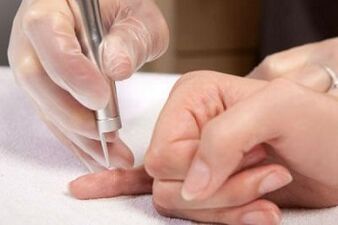 cómo deshacerse de los papilomas en el cuerpo