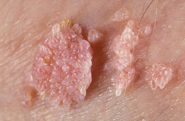 El papiloma es una formación benigna similar a un tumor de la piel y las membranas mucosas de naturaleza verrugosa. 
