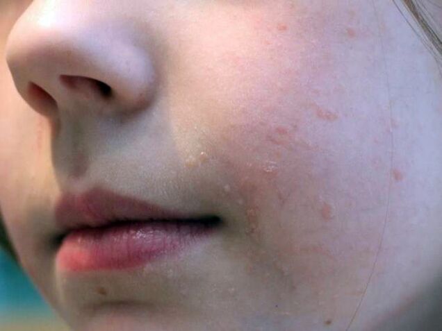 Las verrugas planas en la cara aparecen con mayor frecuencia durante la adolescencia. 